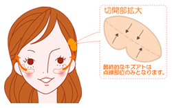 こめかみリフト