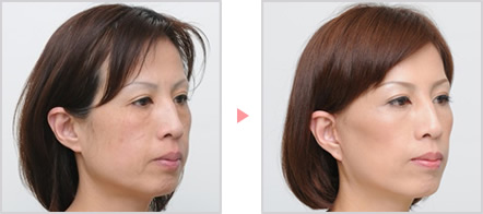 フェイスリフトの症例写真