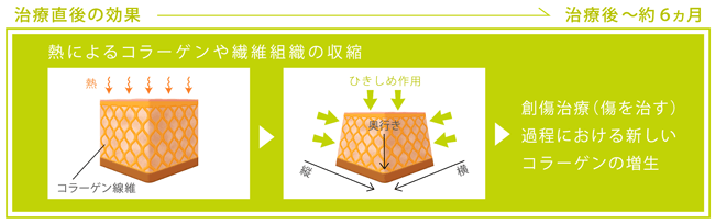 サーマクールCPTの仕組み