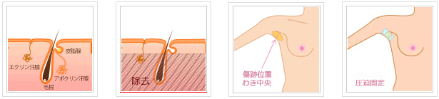 切開(剪除法)によるわきが・多汗症治療