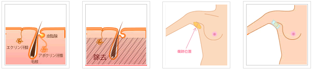 シェービング法