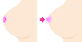 陥没乳頭の治療