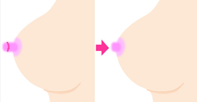 乳頭縮小の治療