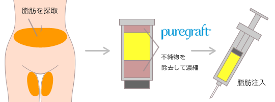 ピュアグラフトによる豊胸