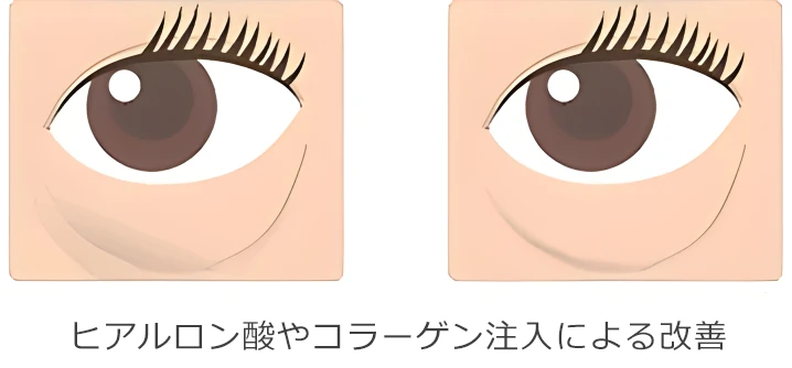 注入によるくま治療