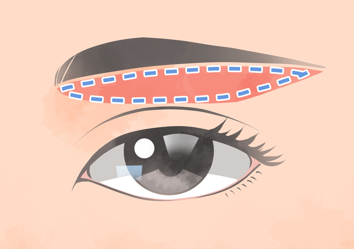 眉下切開の治療