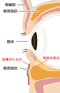 下まぶたのくまの原因
