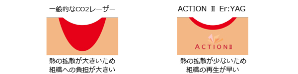 CO2レーザーとの比較