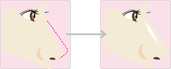 隆鼻手術（プロテーゼ挿入）
