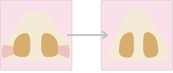小鼻（鼻翼）が広がっている方(外側切除)