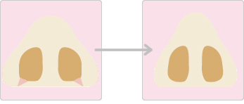 鼻の幅が広い方(内側切除)